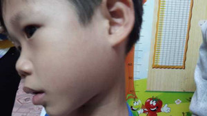 Vì sao tiêm phòng vắc xin quai bị rồi vẫn mắc bệnh?