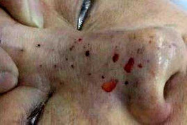 Hai phụ nữ bị hoại tử mũi, biến dạng mặt vì bơm chất làm đầy