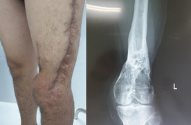 Lần đầu ghép cơ phục hồi chân cho nạn nhân bị tai nạn giao thông