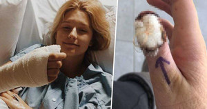 Video: Cô gái phải cắt bỏ ngón tay vì thói quen cắn móng tay