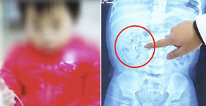 Bổ sung canxi quá liều, bé 9 tháng tuổi thận đầy sỏi