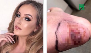 Video: Đi dép quai hậu, nữ người mẫu suýt phải cắt chân