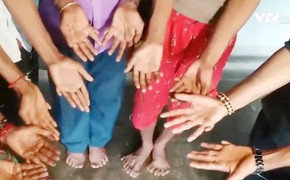 Kỳ lạ cả gia đình 25 người đều bị tật thừa ngón