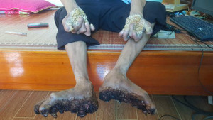 Video: Căn bệnh 'người cây' được ghi nhận ở Việt Nam