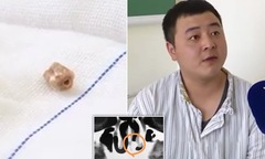 Chàng trai có răng trong mũi 20 năm không hề hay biết