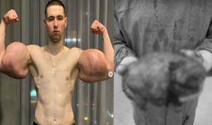 Video: Bơm 3 lít dầu vào tay, vận động viên thể hình bị thối hết cơ bắp