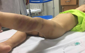 Nghi vấn bé trai 14 tháng tuổi bị đánh bầm tím khắp người, bỏ lại bệnh viện