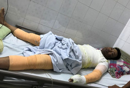 Nổ bình gas, một người đàn ông cháy sém mặt, bỏng toàn thân