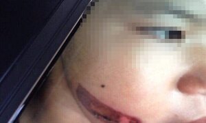 Bé gái 7 tuổi bị cha đẻ, mẹ kế dí thanh sắt nung đỏ vào mặt