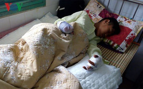 Nam sinh bị dập nát 2 bàn tay vì pháo nổ