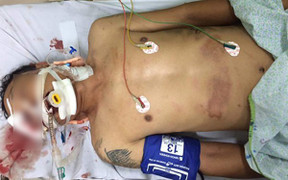 Ô tô kéo lê người đàn ông hàng trăm mét trên phố Hà Nội: Nạn nhân vỡ xương quai hàm