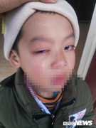 Phụ huynh tố cô giáo dùng thước đánh sưng mắt học sinh, nguy cơ mù một bên