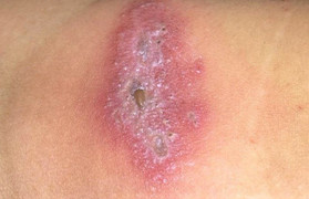 Bệnh viện ở TP.HCM xuất hiện kiến ba khoang tấn công bệnh nhân