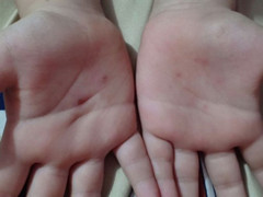 Làm rõ nghi vấn giáo viên mầm non dùng vật nhọn đâm vào tay học sinh