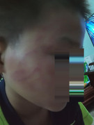 Phụ huynh tố thầy giáo đánh học sinh bầm tím mặt, nhà trường nói gì?