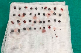 Nam thanh niên Hà Tĩnh bị gần 40 viên đạn găm trên mặt