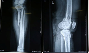 Băng qua đường, người đàn ông bị xe đâm gãy chân, tổn thương mạch máu