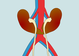 Mắc bệnh thận móng ngựa hiếm gặp, hai quả thận của người đàn ông đầy mủ, ứ nước