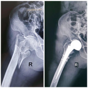 Phẫu thuật thay khớp háng cho cụ ông 96 tuổi, mang trong mình cả ‘núi bệnh’