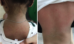 Mắc hội chứng lạ, bé gái 3 tuổi bong tróc da toàn thân như da rắn