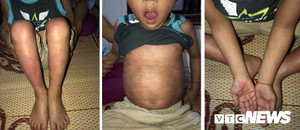 Hồi phục kỳ diệu, bé trai 5 tuổi ở Cao Bằng mắc bệnh khó chữa vừa được ra viện