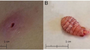Đi trăng mật về, người phụ nữ bị ấu trùng ruồi làm tổ dưới da