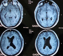 Cứu sống ngoạn mục người đàn ông có khối u khổng lồ trong não