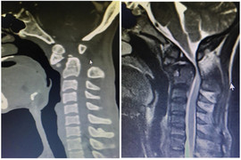 Chủ quan đắp thuốc nam chữa bệnh tại nhà, người đàn ông suýt liệt toàn thân