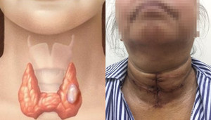 Ba lần phẫu thuật cứu người phụ nữ có khối u khổng lồ từ cõi chết trở về