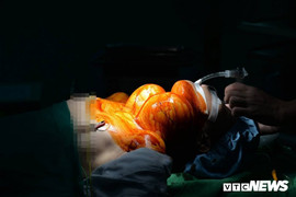 Người phụ nữ 47 tuổi mang khối u giáp nặng ‘trĩu cổ’