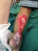 Đùa nghịch cho chân vào bánh xe đang chạy, bé 2 tuổi bị đứt gân, lộ xương gót chân