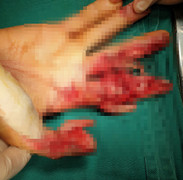 Người phụ nữ 48 tuổi bị máy xay thịt nghiền nát bàn tay