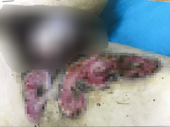 Đắp thuốc nam chữa bỏng, vùng kín của người đàn ông bị chảy mủ, bốc mùi hôi thối