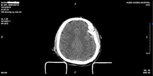 Cứu sống nam thanh niên bị tai nạn lún xương sọ, dập não
