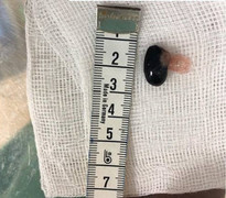 Hóc hạt mãng cầu, bé trai ngừng tim, ngừng thở suýt chết