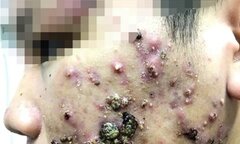 Dùng mỹ phẩm không rõ nguồn gốc, nhiều nữ sinh bị 'nát mặt'