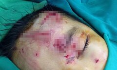 Bé trai 7 tuổi bị chó nhà cắn thương tâm