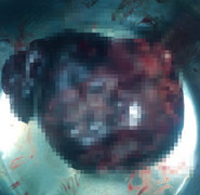 Cụ bà 89 tuổi nặng vỏn vẹn 28 kg có khối u buồng trứng khổng lồ