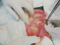 Cứu bé 36 tháng tuổi thủng ruột nguy kịch