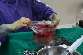 Người phụ nữ có khối u xơ tử cung to như bầu 5 tháng