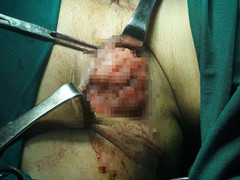 Khối u 'lạ' chi chít trên cơ thể ba người đàn ông, nghi do uống nhiều rượu