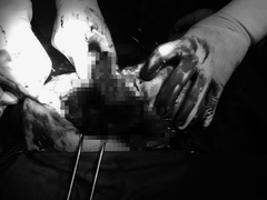 Sinh nở tại nhà, sản phụ vỡ tử cung, con chết lưu trong bụng mẹ