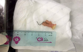 Sau cơn ho, răng giả chui ‘tọt’ vào cổ họng người đàn ông 35 tuổi