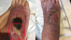 Kỳ lạ: Cấy 400 con giòi vào chân bị thương của người đàn ông để trị bệnh