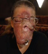 Khối u khổng lồ che kín khuôn mặt cô bé 14 tuổi