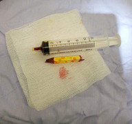 Hai trẻ nghịch dại dẫn đến tai nạn đáng tiếc, nhập viện cấp cứu trong đêm