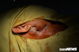 Đắp lá thuốc trị tiểu đường, người đàn ông nhập viện ngày cận Tết