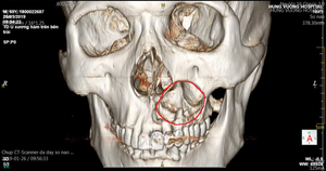 Ngã gãy răng tưởng đơn giản, tới viện mới biết có u nang hàm trên