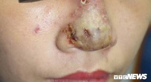 ‘Nát mặt’ vì tiêm chất tan mỡ tạo cằm V-line đón Tết