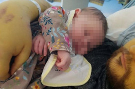 ‘Nốc’ 1 lít rượu, 20 lon bia mỗi ngày, thanh niên 26 tuổi suy gan nguy kịch